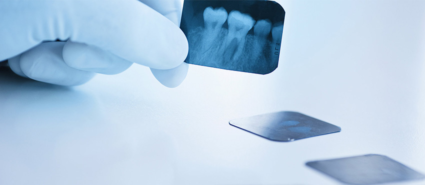 Что делать перед имплантацией зубов
