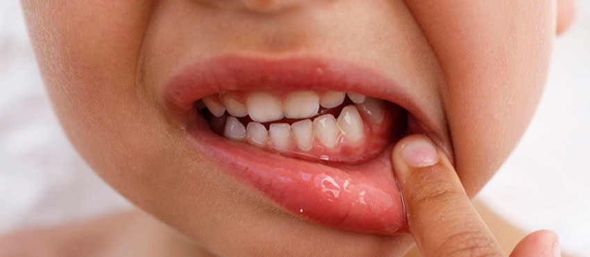 Как лечить стоматит у детей - стоматологическая клиника «Медицентр»
