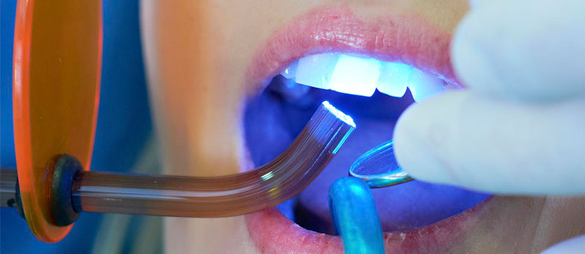 Лечение кариеса передних зубов в СПб