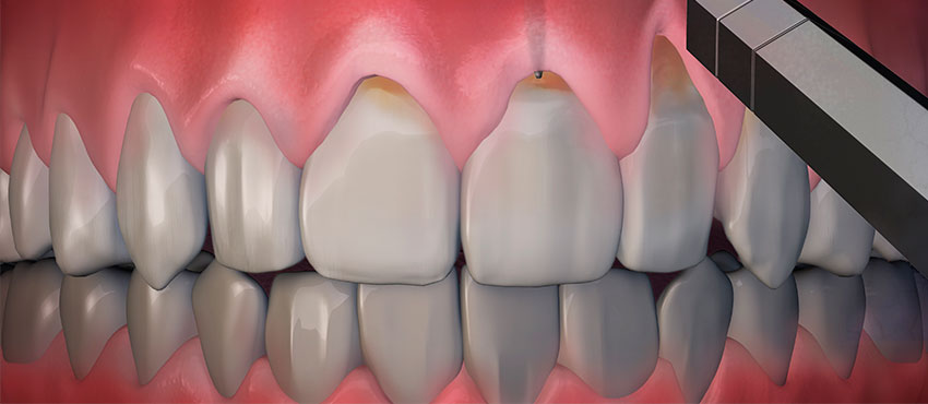 Оголение шейки зуба - стоматологическая клиника «Медицентр»