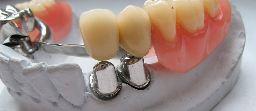 Шаровидный протез на имплантах - стоматологическая клиника «Медицентр»