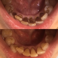 Чистка зубов - до и после (2)