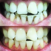 Чистка зубов - до и после (3)