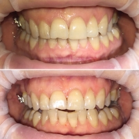 Чистка зубов - до и после