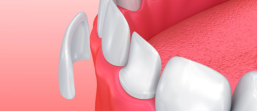 Что такое виниры на зубы - стоматологическая клиника «Медицентр»