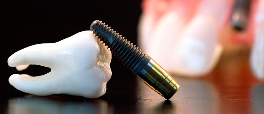 Импланты зубов: виды и цены