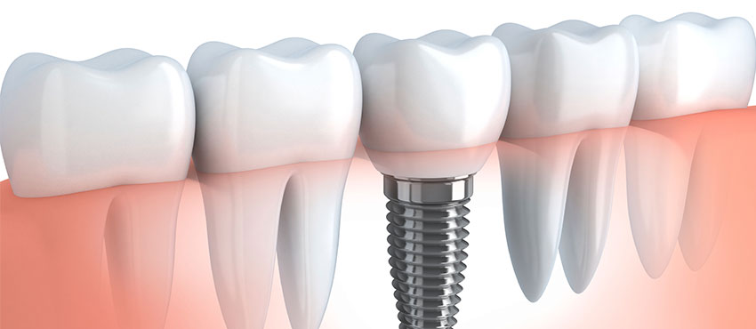 Какие зубные протезы лучше поставить: съемные зубные протезы, несъемные зубные протезы, мягкие зубные протезы