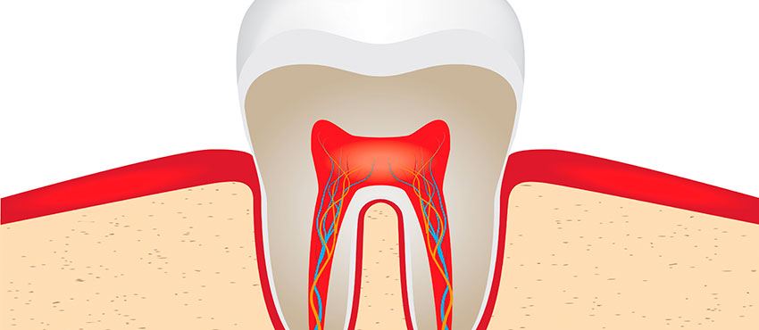 Классификация пульпитов - стоматологическая клиника «Медицентр»