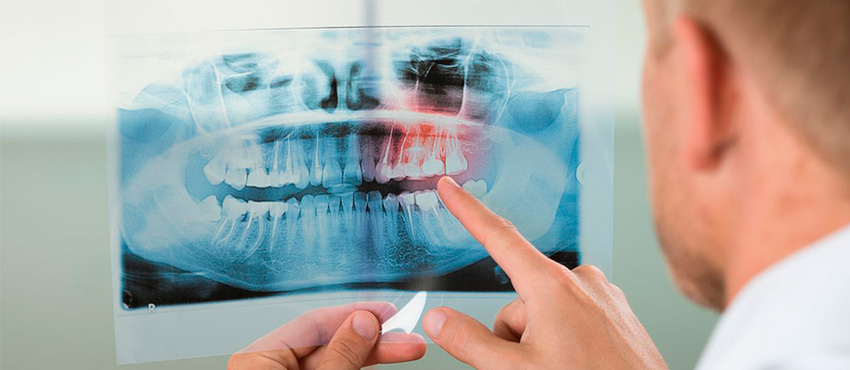 Костная пластика при имплантации зубов в СПб