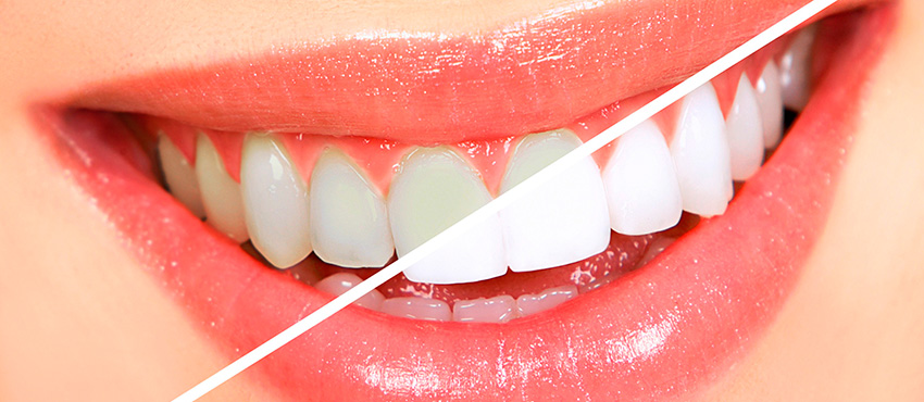 Минусы отбеливания зубов