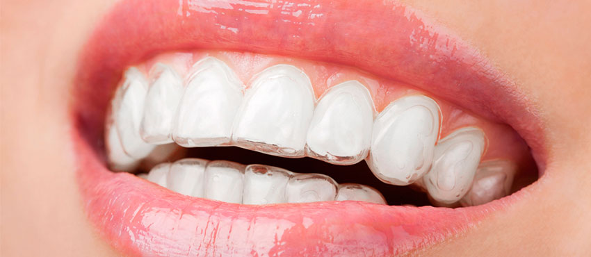Ретенционный период: сохранить ровные зубы после брекетов