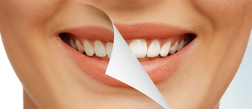 Способы отбеливания зубов в стоматологии Приморского района